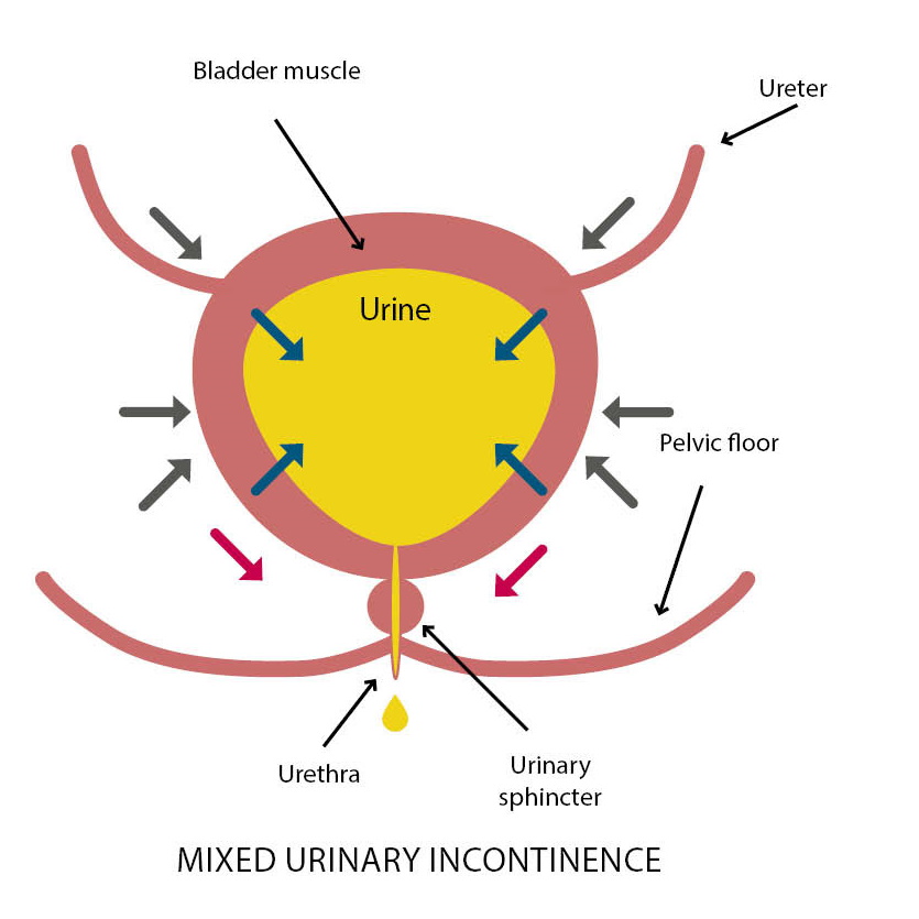 Urinary incontinence